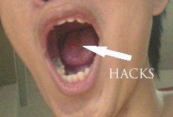 hacks in mouth